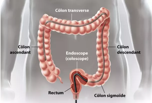 coloscopie