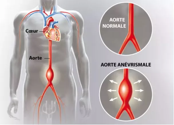 aorte abdominale
