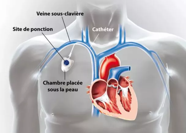 chambre implantable