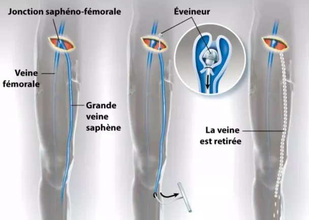 varices