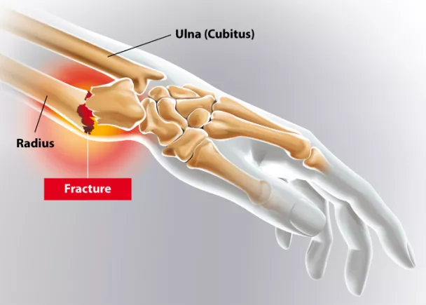 Fracture du poignet | Clinique La Croix du Sud